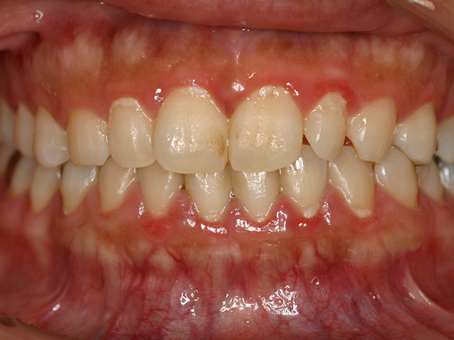 歯周病図1