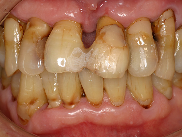 歯周病図2