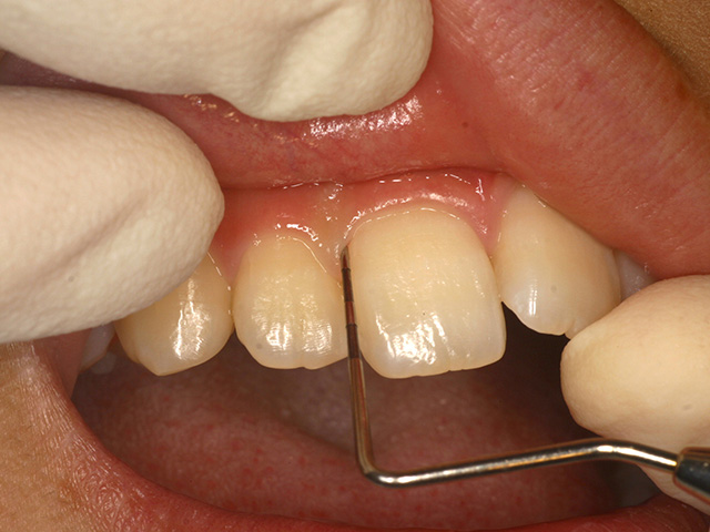 歯周病図3