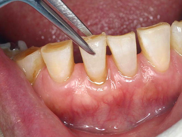 歯周病図5