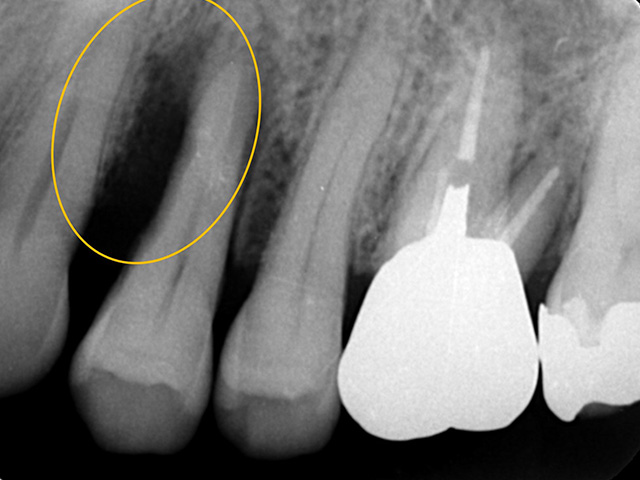 歯周病図6